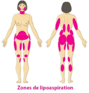 Liposuccion et Lipoaspiration